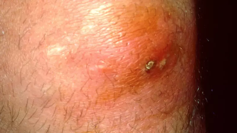 Furúnculo pode ser fatal? Dermatologista alerta sobre riscos subestimados