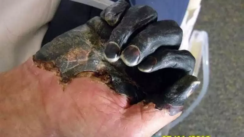 Peste Negra no Século XXI: Americano Contrai Doença Medieval Após Picada de Pulga
