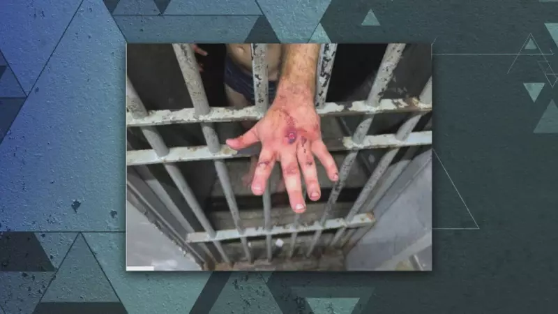 Vítima de espancamento em elevador sofre lesões equivalentes a acidente de moto sem capacete