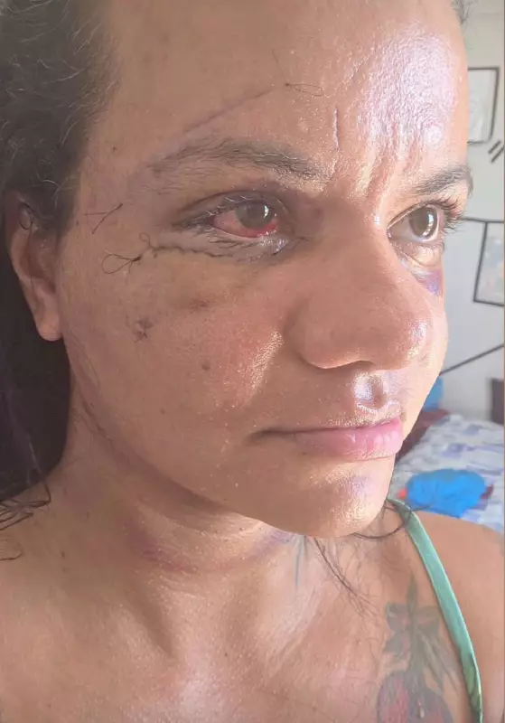 Vítima de violência doméstica revela rosto após cirurgia de reconstrução facial no RN