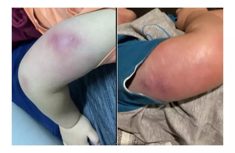 Alerta em Maceió: Bebê de 1 ano internado com infecção grave após receber vacinas de rotina