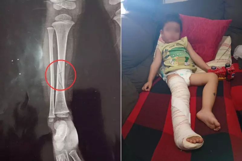Criança de 2 anos sofre fratura em creche de SP: mãe relata desamparo e negligência