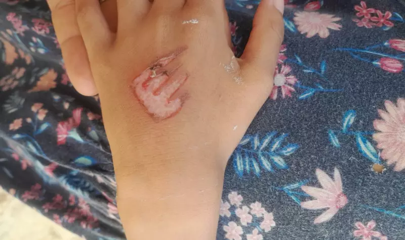 Mãe queima filha com garfo quente em Recife: caso choca e levanta debate sobre violência doméstica