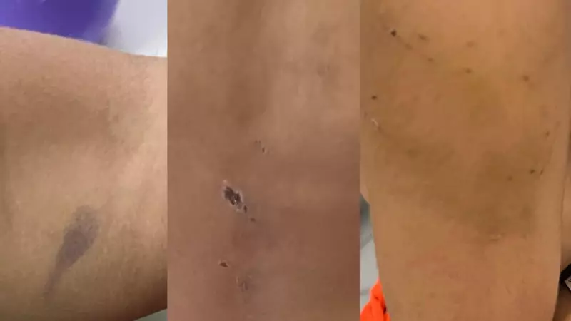 Olinda em Choque: Criança de 4 Anos Vítima de Tortura por Pai e Madrasta com Queimaduras de Cigarro