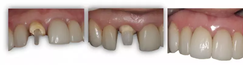 Prótese Dentária: Como Especialização Transforma Sorrisos e Vidas em Mato Grosso