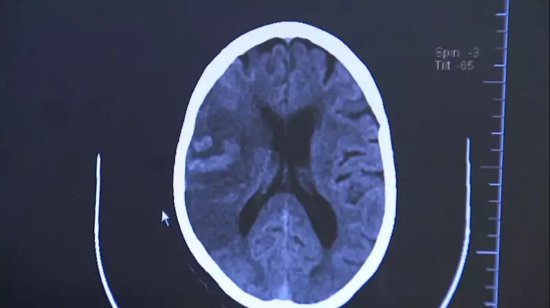 AVC na Região de Piracicaba: Atendimentos Ambulatoriais Disparam 247% | Saiba Como se Proteger