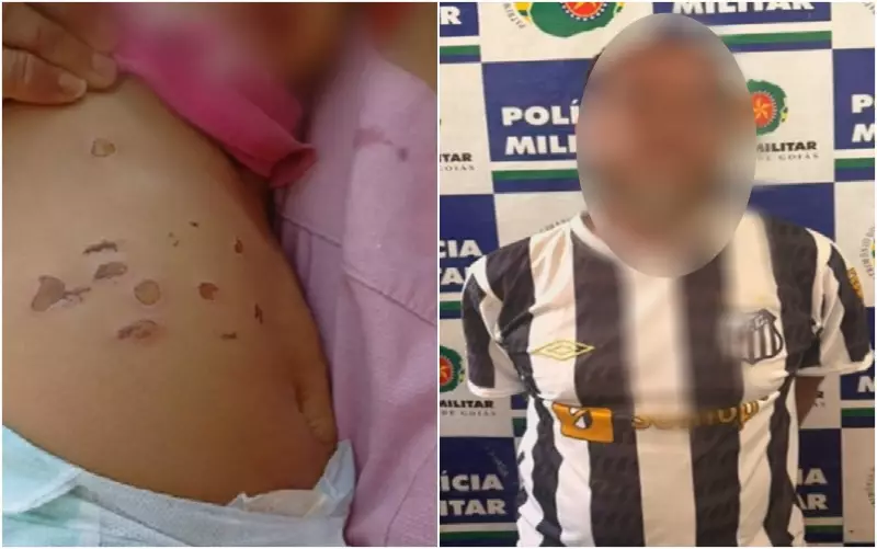 Bebê de 1 ano é internada com queimaduras de cigarro em Goiás: caso investigado como suspeita de maus-tratos