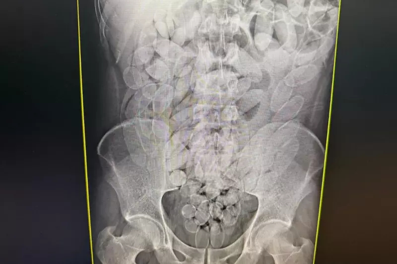 Bolivianos presos em Corumbá com 645 cápsulas de cocaína no estômago | Operação de combate ao tráfico internacional