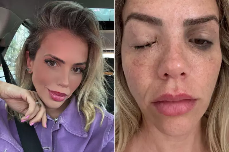 Celulite Ocular: Apresentadora Contrai Bactéria Rara que Pode Cegar em Apenas Horas