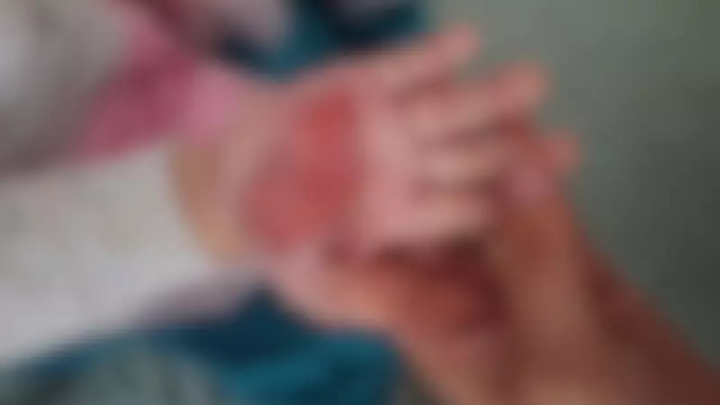 Mulher é investigada por queimar mão de enteada de 2 anos com colher quente como castigo em SC