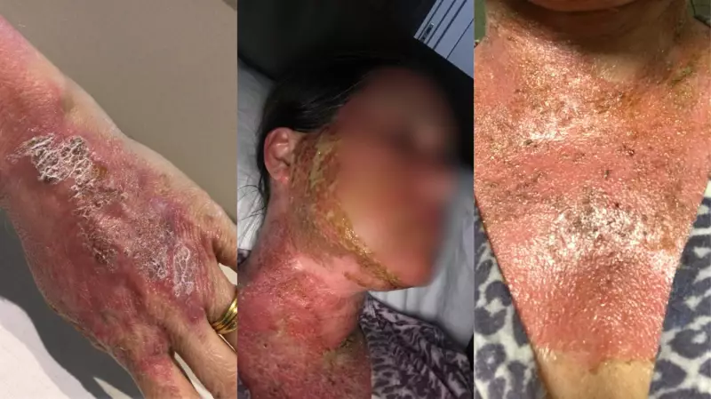 Procedimento Estético Vira Pesadelo: Mulher Sofre Queimaduras Graves Após Peeling no Paraná