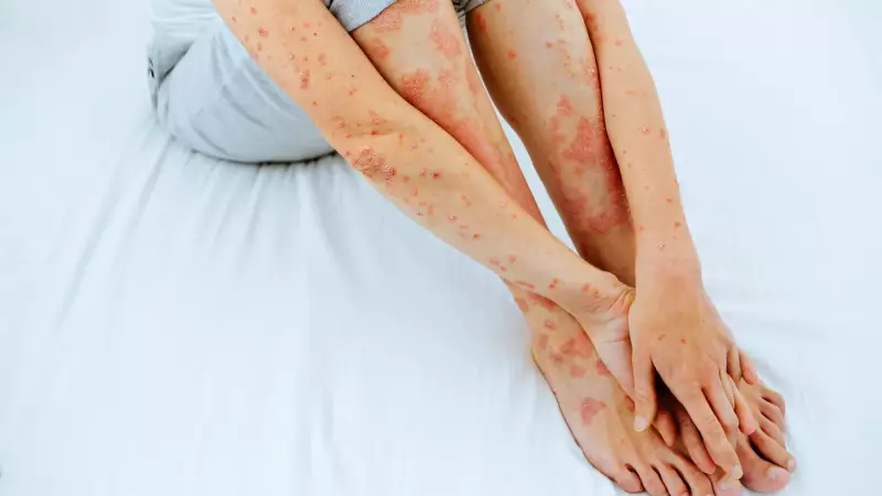 Psoríase NÃO É Contagiosa: Descubra Como o Estresse Pode Desencadear as Crises