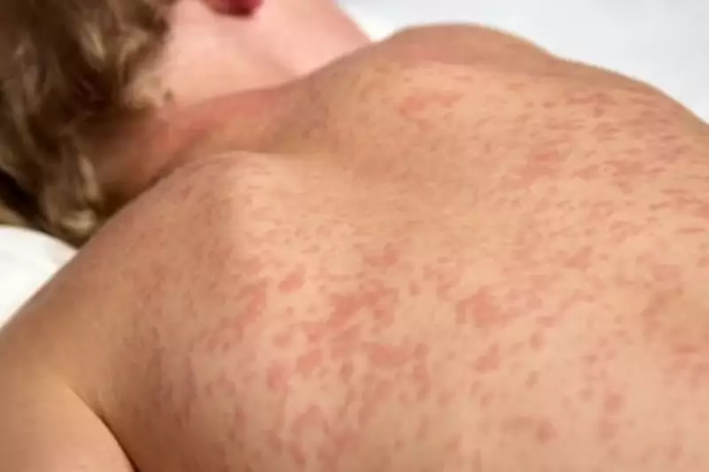 Sarampo em Uberlândia: Estado monta força-tarefa contra surto com 9 casos suspeitos