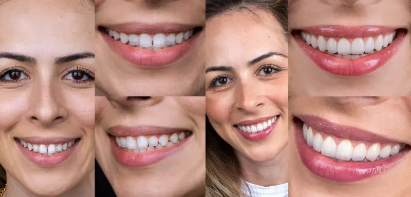 De Santos para o Mundo: Como a Odontologia Está Transformando Sorrisos com Lentes e Implantes