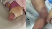 Bebê de 6 meses sofre lesão grave no pé após erro em hospital do Ceará