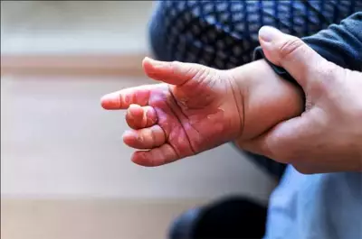 Amapá registra 15 casos de queimaduras em crianças de 1 a 4 anos em 2025