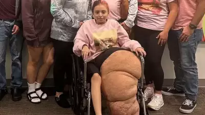 Jovem de 14 anos tem perna amputada após tumor raro atingir 79 kg