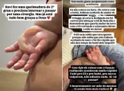Filho de Viih Tube sofre queimadura grave: entenda os riscos para bebês