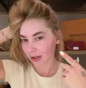 Virginia Fonseca se arrepende de procedimento estético que deixou rosto 'em carne viva'