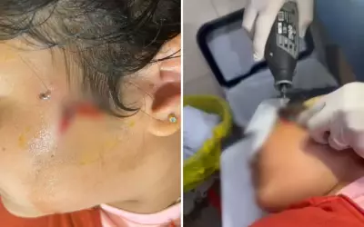 Criança de 10 anos fica com anzol preso no rosto durante pescaria em Luziânia