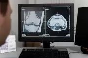 Genética explica gravidade da osteoartrite de joelho em mulheres, revela estudo brasileiro