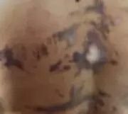 Mulher relata queimaduras após cesariana e falta de apoio em hospital de Arraial do Cabo