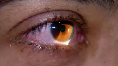 Limpeza inadequada de lentes de contato pode causar infecções graves e até transplante de córnea