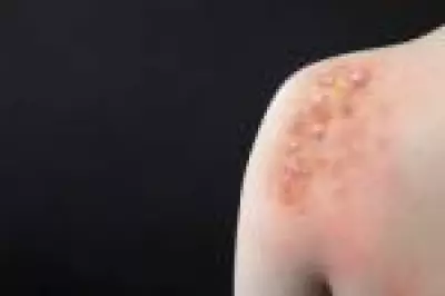 Porto Alegre confirma caso de Mpox e alerta para Carnaval após infecção contraída fora do RS