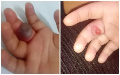 Menina de 2 anos tem dedo ferido após picada de aranha em Sorocaba; mãe suspeita de creche