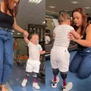 Criança de 1 ano supera amputações e desvio de doações para dar primeiros passos com próteses