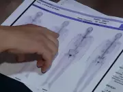 Fibromialgia: Atendimentos no SUS crescem 35,4% em São Paulo; Campinas registra alta de 33,5%