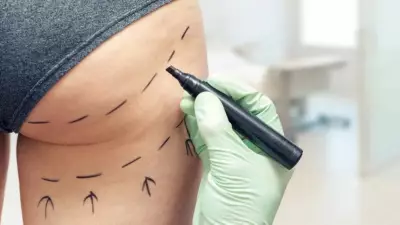 Cirurgia de aumento do bumbum tem maior taxa de mortalidade entre procedimentos estéticos