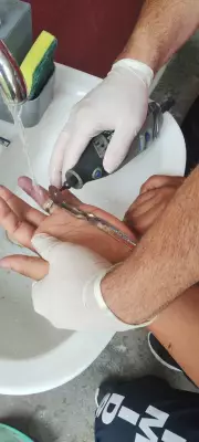 Mais de 500 pessoas socorridas com anéis presos aos dedos em Manaus em 2025