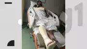 Ciclista é atropelado por patinete elétrico compartilhado no Recife e sofre fratura no cotovelo