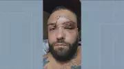 Designer de moda leva 35 pontos no rosto após agressão homofóbica em bar de Mesquita