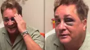 Leonardo sofre acidente durante pescaria no Pantanal e fica com hematoma no olho
