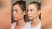 Lifting facial se reinventa: técnicas modernas garantem rejuvenescimento natural
