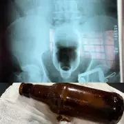 Plug anal é 'sugado' pelo intestino e mulher precisa ser internada; médicos alertam para riscos