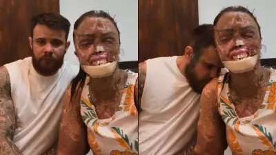 Dermatologista explica Xeroderma Pigmentoso, doença rara de influenciadora