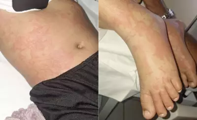 Menina internada com suspeita de contaminação por detergente tem infecção viral