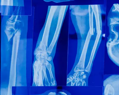 Osteopenia: condição silenciosa afeta 40% dos adultos no mundo