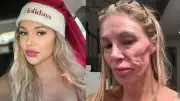 Brandi Glanville culpa parasita sexualmente transmissível por deformação facial