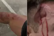 Guarda-vidas ferido após assalto por ladrões de bicicleta em Guarujá