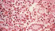 Infectologista explica contágio e sintomas do hantavírus no RS