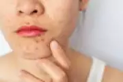 Nova diretriz europeia atualiza tratamento da acne após quase uma década