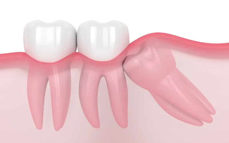 Siso ou Ciso: Origem do Dente do Juízo Explicada