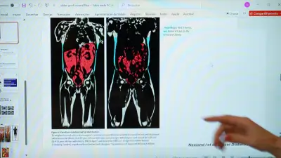 Gordura visceral é a mais perigosa para a saúde, alerta estudo