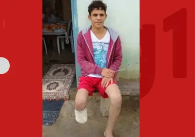 Homem amputa próprio pé para receber R$ 1,5 milhão de seguro e é condenado