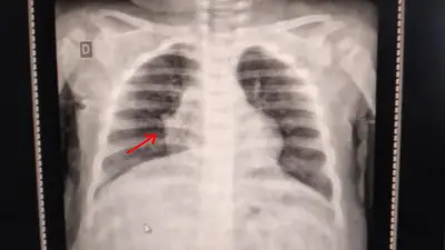 Justiça determina internação de bebê com pneumonia em até 24h em Araçatuba