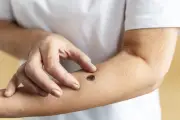 5 sinais de câncer de pele que você nunca deve ignorar